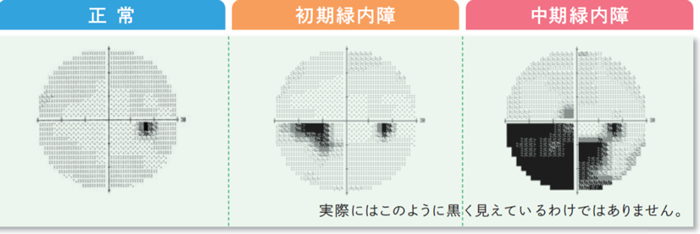 自動視野計AP7700