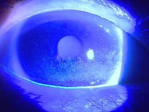 涙液層破壊時間(BUT)検査