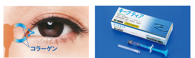 キープティア(コラーゲン製涙点プラグ)