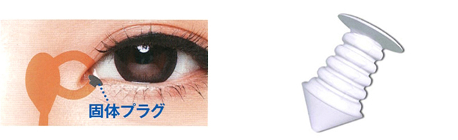 涙点プラグ挿入術(スパーフレックスプラグ)